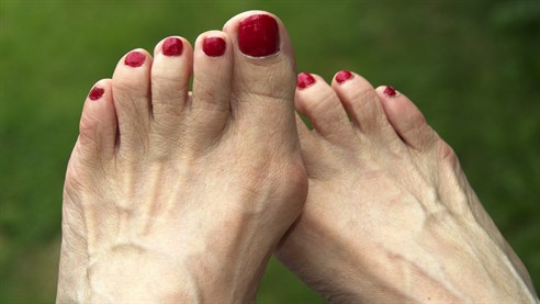 More than 15% of women in the UK suffer from bunions