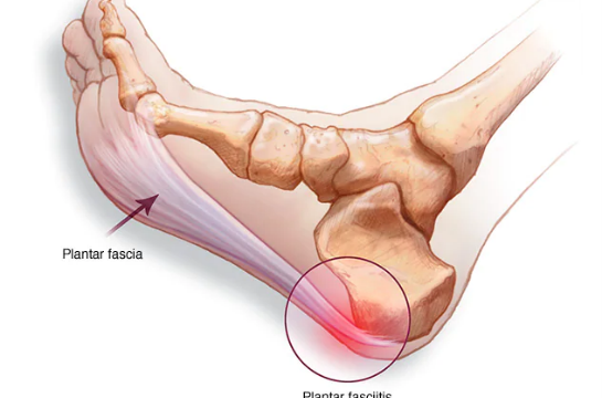 What causes heel pain?