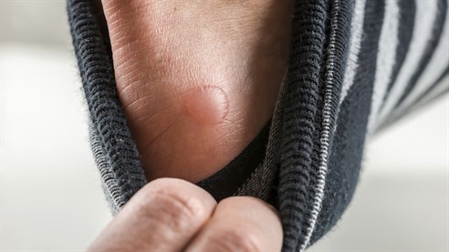 Having problems with blisters?