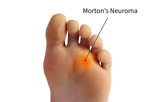 Morton’s neuroma