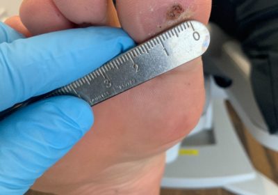 Swift Microwave Therapy for Verrucae