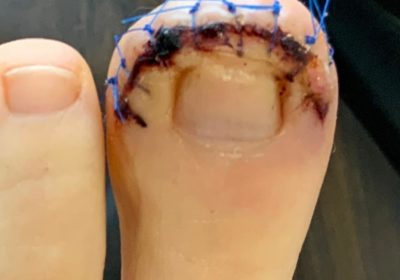 Dubois Procedure Belfast | Toe Soft Tissue Surgery
