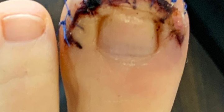 Dubois Procedure Belfast | Toe Soft Tissue Surgery